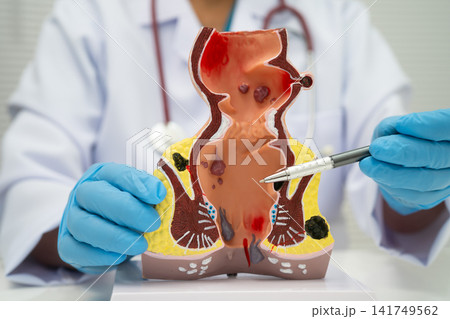 Asian doctor with rectum and hemorrhoid human anatomy model at hospital, inflamed vascular structure. Asian doctor with rectum and hemorrhoid human anatomy model at hospital, inflamed vascular structure. 141749562