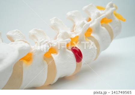 Lumbar spine displaced herniated disc fragment, spinal nerve and bone. Model for treatment medical in the orthopedic department. Lumbar spine displaced herniated disc fragment, spinal nerve and bone. Model for treatment medical in the orthopedic department. 141749565