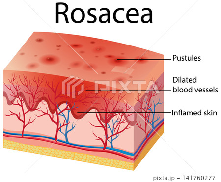 Medical Diagram of Rosacea Skin Condition with Labeled Anatomy 141760277