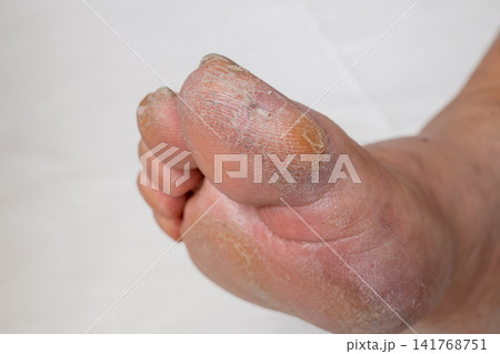 Close-Up of Male Foot with Callus on Big Toe Against White Background Close-Up of Male Foot with Callus on Big Toe Against White Background 141768751