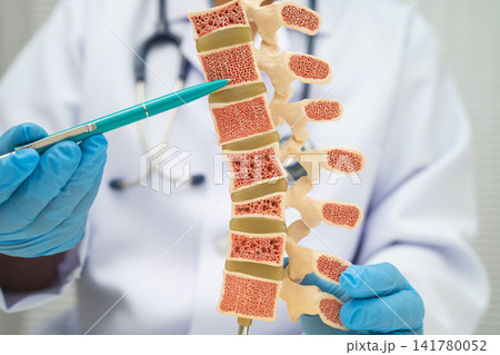 Doctor holding osteoporosis in back bone model. Doctor holding osteoporosis in back bone model. 141780052