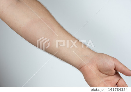 Erythema migrans rash on human skin caused by Lyme disease from a tick bite 141784324
