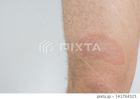 Erythema migrans rash on human skin caused by Lyme disease from a tick bite 141784325