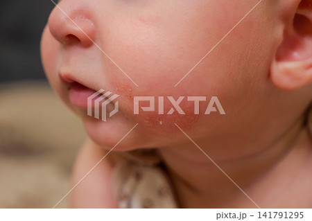 Infant lower face with mild cheek rash and dry skin Infant lower face with mild cheek rash and dry skin 141791295