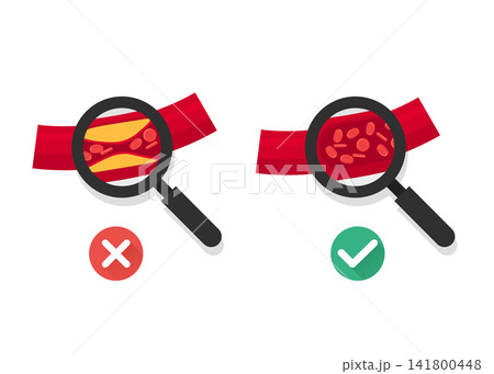 arterial health comparison of clogged versus clear blood vessels arterial health comparison of clogged versus clear blood vessels 141800448