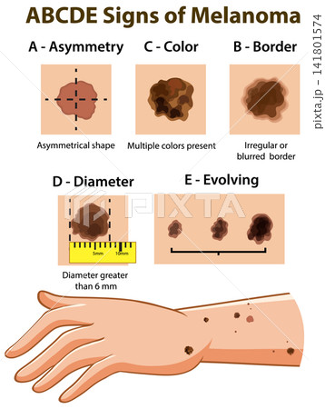 ABCDE Signs of Melanoma Skin Cancer Medical Education Infographic ABCDE Signs of Melanoma Skin Cancer Medical Education Infographic 141801574
