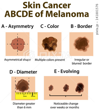 Medical Infographic Explaining the ABCDE Rule for Skin Cancer Melanoma Detection Medical Infographic Explaining the ABCDE Rule for Skin Cancer Melanoma Detection 141801576