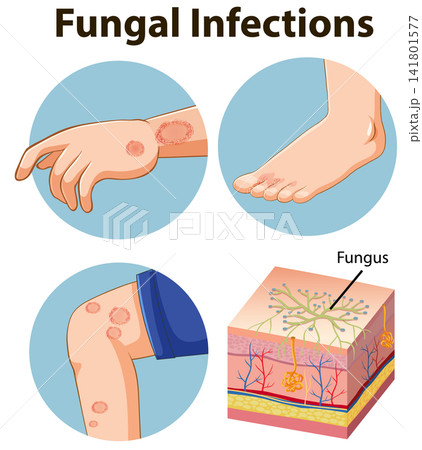 Medical Illustration of Fungal Skin Infections and Cross Section Anatomy Medical Illustration of Fungal Skin Infections and Cross Section Anatomy 141801577