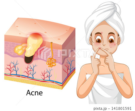 Medical Illustration of Acne Skin Disease and Woman Squeezing Pimple Medical Illustration of Acne Skin Disease and Woman Squeezing Pimple 141801591