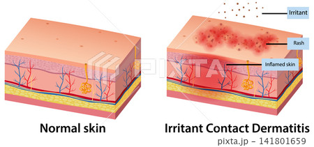 Medical Diagram Comparing Normal Skin and Irritant Contact Dermatitis Medical Diagram Comparing Normal Skin and Irritant Contact Dermatitis 141801659