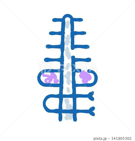 Spine anatomy displaying disc herniation and nerve compression 141805302