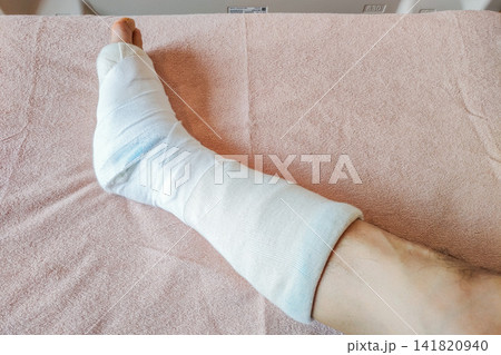 アキレス腱断裂の手術後にギブス固定された右足(左側) アキレス腱断裂の手術後にギブス固定された右足(左側) 141820940