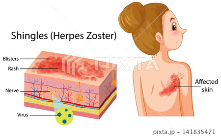 Medical Diagram of Shingles Herpes Zoster Skin Disease and Anatomy 141835471
