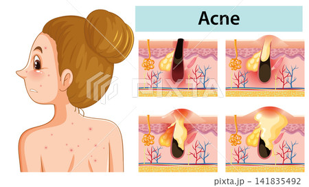 Medical Illustration of Acne Development and Skin Pore Inflammation 141835492