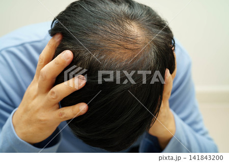 Bald in the middle head and begin no loss hair glabrous of mature man. Bald in the middle head and begin no loss hair glabrous of mature man. 141843200
