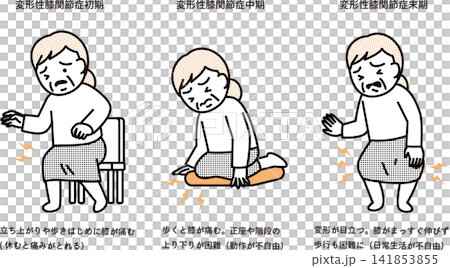 膝關節骨關節炎的症狀 膝關節骨關節炎的症狀 141853855