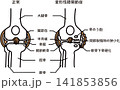 変形性膝関節症の病態図 141853856