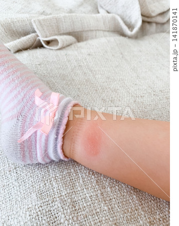 A close up of a small child wearing a white striped sock with a small pink ribbon on the ankle resting on a soft white fabric A close up of a small child wearing a white striped sock with a small pink ribbon on the ankle resting on a soft white fabric 141870141
