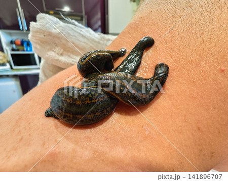 Medicinal leeches attaching to skin on a person's arm for hirudotherapy, providing blood treatment as an alternative medicine approach. 141896707