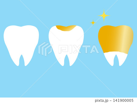 歯のかぶせ物のイラスト 金歯 歯のかぶせ物のイラスト 金歯 141900005