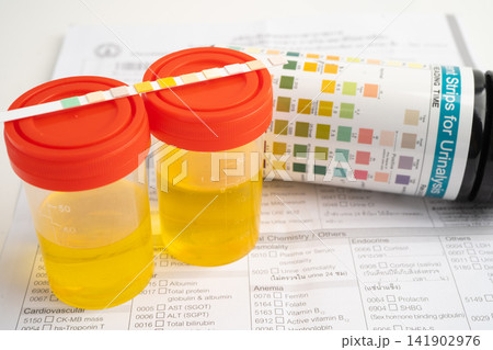 Urinalysis, urine cup with reagent strip pH paper test and comparison chart in laboratory. Urinalysis, urine cup with reagent strip pH paper test and comparison chart in laboratory. 141902976