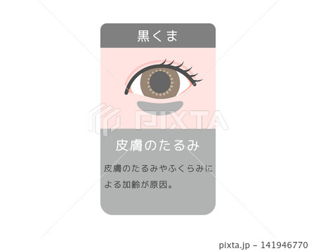 目のクマの種類イラスト(黒クマ)皮膚のたるみと説明文 目のクマの種類イラスト(黒クマ)皮膚のたるみと説明文 141946770