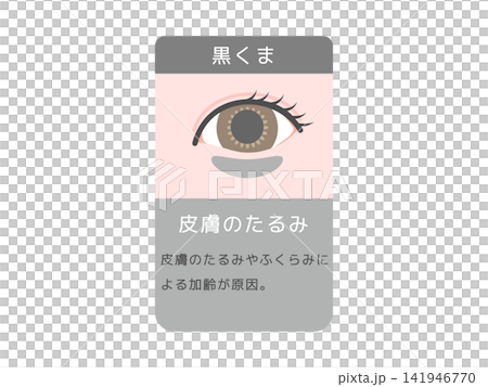 目のクマの種類イラスト(黒クマ)皮膚のたるみと説明文 目のクマの種類イラスト(黒クマ)皮膚のたるみと説明文 141946770