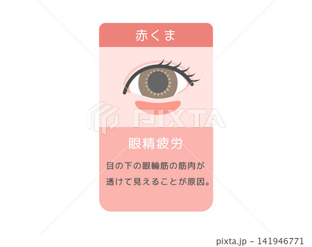 目のクマの種類イラスト(赤クマ)眼精疲労と説明文 目のクマの種類イラスト(赤クマ)眼精疲労と説明文 141946771