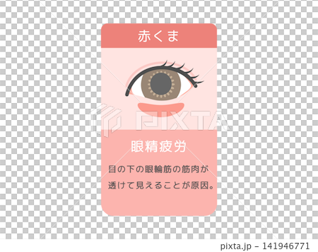 目のクマの種類イラスト(赤クマ)眼精疲労と説明文 目のクマの種類イラスト(赤クマ)眼精疲労と説明文 141946771