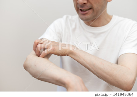 腕の激しい痒みで皮膚を掻きむしるミドル男性 痒い 痒み 腕の激しい痒みで皮膚を掻きむしるミドル男性 痒い 痒み 141949364