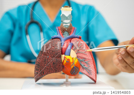 Pneumonia, lung cancer, Asian doctor holding human anatomy model for study diagnosis and treatment in hospital. Pneumonia, lung cancer, Asian doctor holding human anatomy model for study diagnosis and treatment in hospital. 141954803