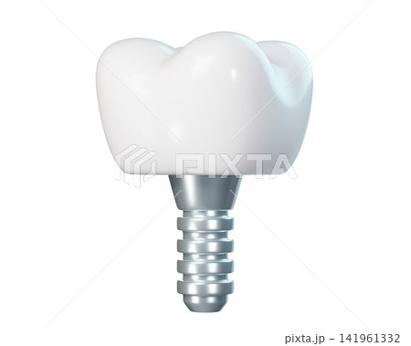 3d Dental implant with ceramic crown isolated on background, modern tooth replacement for dentistry and orthodontic concepts. 3d render 3d Dental implant with ceramic crown isolated on background, modern tooth replacement for dentistry and orthodontic concepts. 3d render 141961332