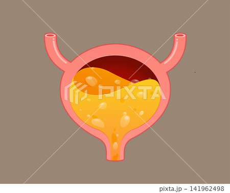 Foamy Urine and Bubbles in Urinary Bladder, Medical Anatomy Illustration Foamy Urine and Bubbles in Urinary Bladder, Medical Anatomy Illustration 141962498