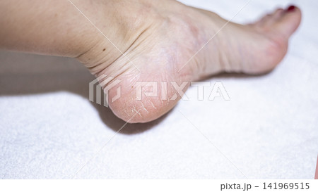 Dry skin on the feet, woman heel Dry skin on the feet, woman heel 141969515