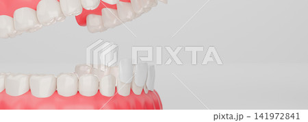 Dental Veneer 3D Illustration Showing Porcelain Veneer Placement on Lower Teeth with Gums Model Dental Veneer 3D Illustration Showing Porcelain Veneer Placement on Lower Teeth with Gums Model 141972841