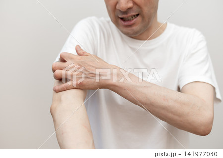 腕の激しい痒みで皮膚を掻きむしるミドル男性 痒い 痒み 腕の激しい痒みで皮膚を掻きむしるミドル男性 痒い 痒み 141977030