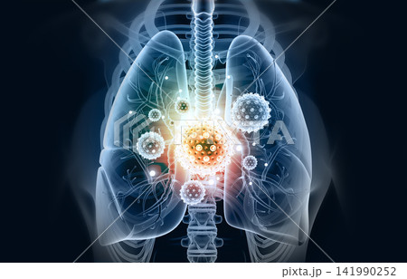 Human lungs infected by virus and bacteria Human lungs infected by virus and bacteria 141990252