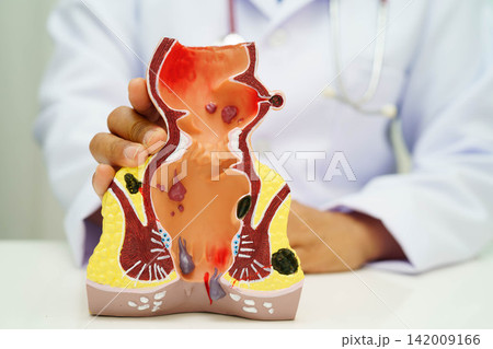 Asian doctor with rectum and hemorrhoid human anatomy model at hospital, inflamed vascular structure. Asian doctor with rectum and hemorrhoid human anatomy model at hospital, inflamed vascular structure. 142009166