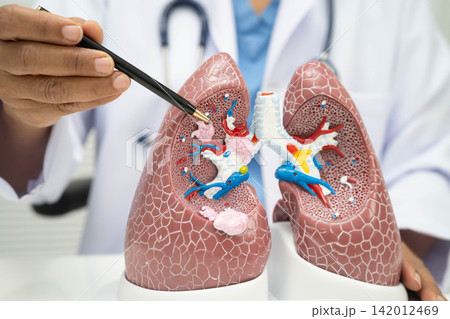 Pneumonia, lung cancer, Asian doctor with human lung model. Pneumonia, lung cancer, Asian doctor with human lung model. 142012469