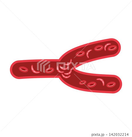 sickle cell disease blood vessel sickle cell disease blood vessel 142032214