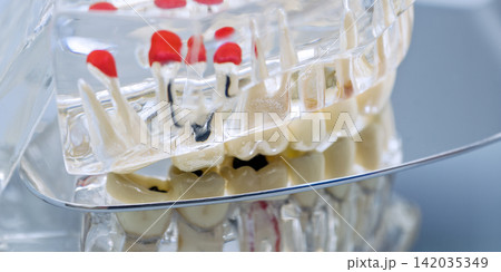 Macro View of Transparent Dental Model Showing Tooth Decay, Cavities, and Root Anatomy 142035349