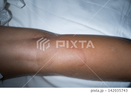 Close-up portrait of a little boy with a red nettle rash on his body 142035743