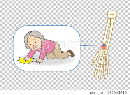 一幅插圖,描繪了一位老婦人摔倒後伸出雙手緩衝,結果導致橈骨骨折的情景。 一幅插圖,描繪了一位老婦人摔倒後伸出雙手緩衝,結果導致橈骨骨折的情景。 142043410