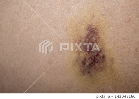 Close Up of a Bruised Skin Area. Close Up of a Bruised Skin Area. 142045160