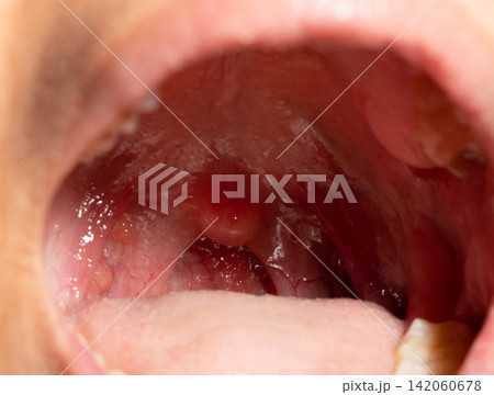 Close up of sore throat showing swollen uvula, inflamed tonsils and posterior pharyngeal wall with lymphoid follicles during upper respiratory tract infection for medical education and healthcare. Close up of sore throat showing swollen uvula, inflamed tonsils and posterior pharyngeal wall with lymphoid follicles during upper respiratory tract infection for medical education and healthcare. 142060678