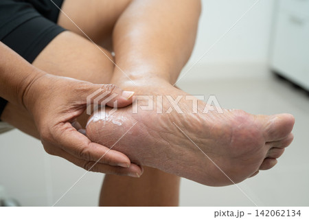 Asian woman check feet with crack and dry heel skin, Diabetic Foot. Asian woman check feet with crack and dry heel skin, Diabetic Foot. 142062134