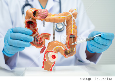 Colorectal cancer, doctor holding intestine colon human anatomy model. 142062138