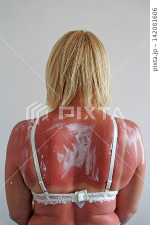 Print of brassiere on female body after beach. Body care Print of brassiere on female body after beach. Body care 142081606