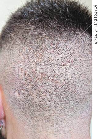 Close-up of shaved scalp with visible dandruff, dry flakes and peeling skin, detailed view of irritated scalp surface and short hair Close-up of shaved scalp with visible dandruff, dry flakes and peeling skin, detailed view of irritated scalp surface and short hair 142101516