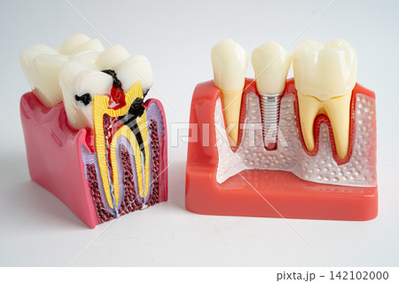 Dental implant, artificial tooth roots into jaw, root canal of dental treatment, gum disease, teeth model for dentist studying about dentistry. Dental implant, artificial tooth roots into jaw, root canal of dental treatment, gum disease, teeth model for dentist studying about dentistry. 142102000